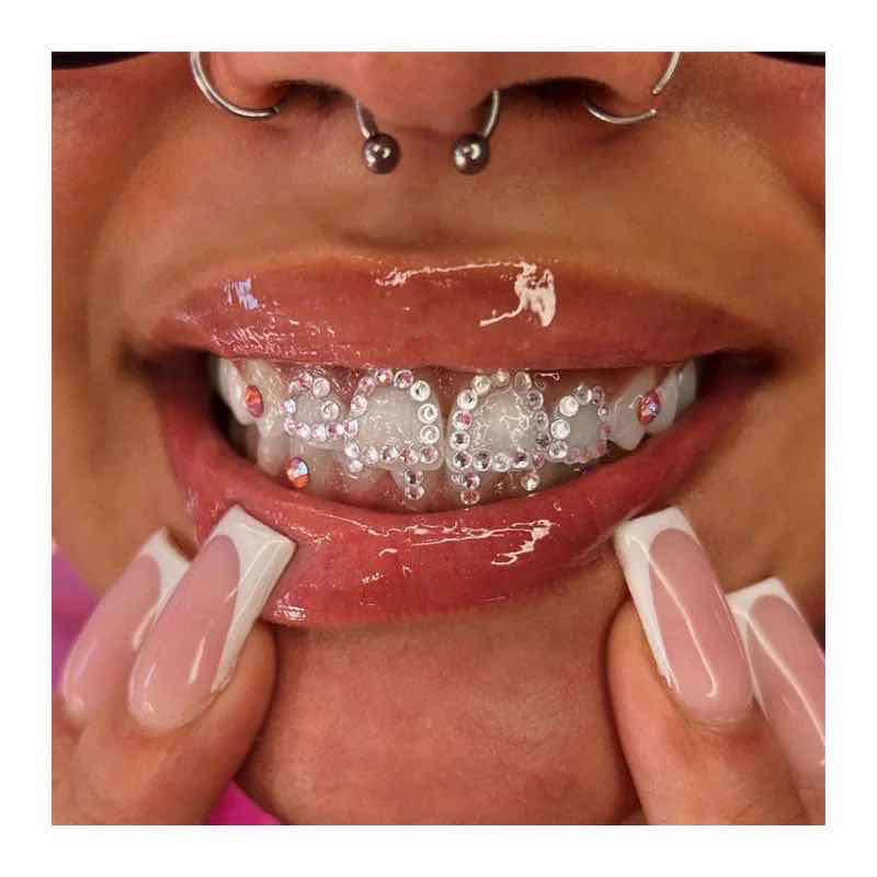 Fashion braces and gems 